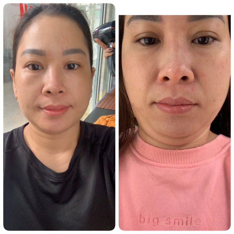 Giảm mỡ mặt cho nữ